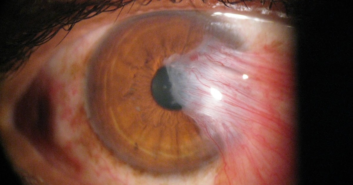 Pterygium Prevention. cause. symptoms and treatment