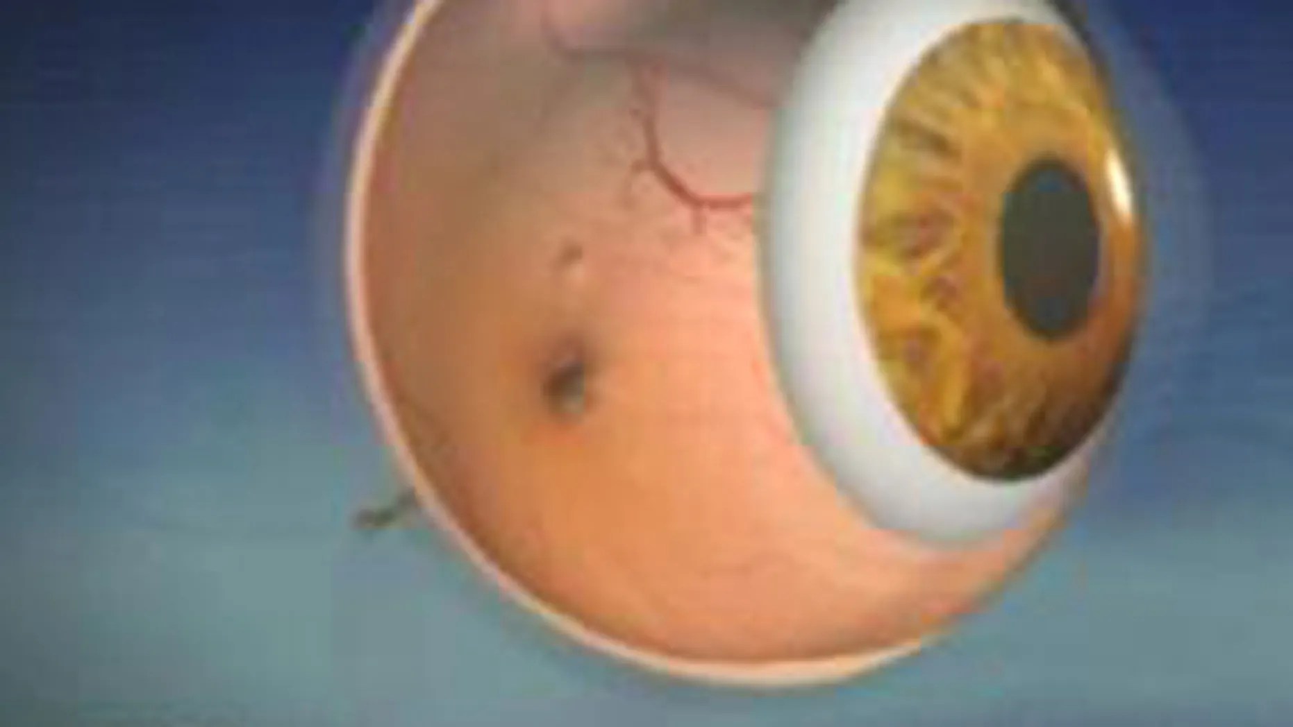 75+ High Definition Cataract Lens Cat Picture
