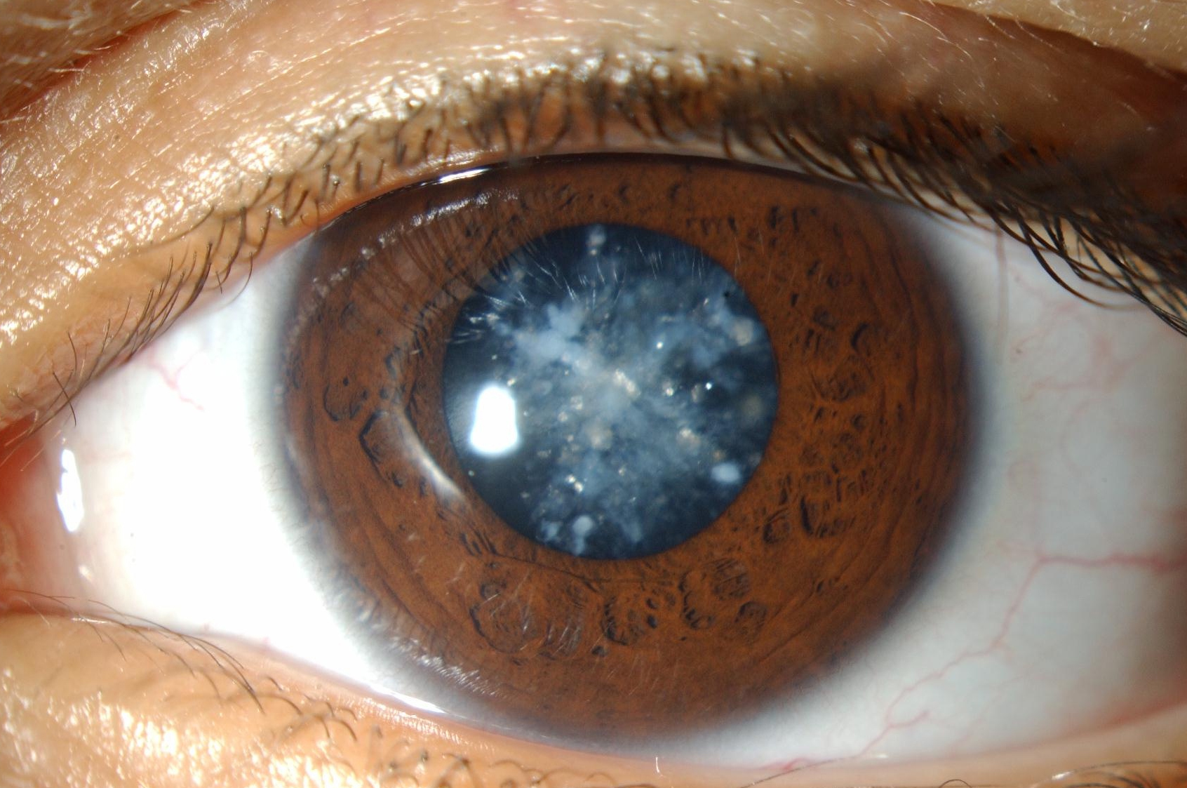 Cataract Surgery at Akstein Eye Center