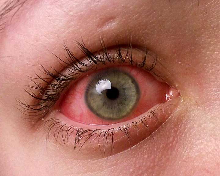 Improper Use of Contact Lenses May Cause Serious Eye
