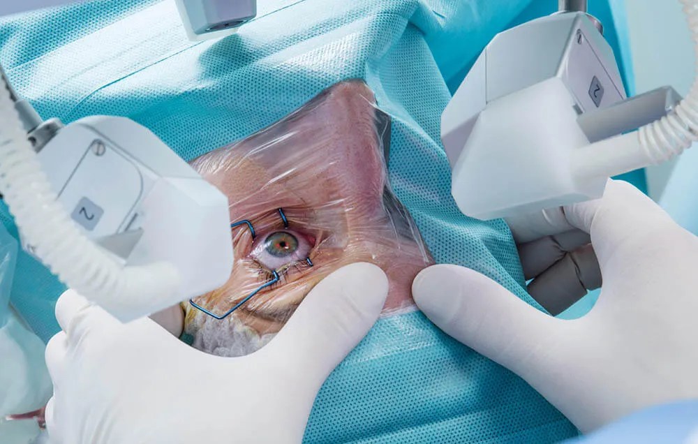 Traditional Cataract Surgery Vs Laserassisted Cataract