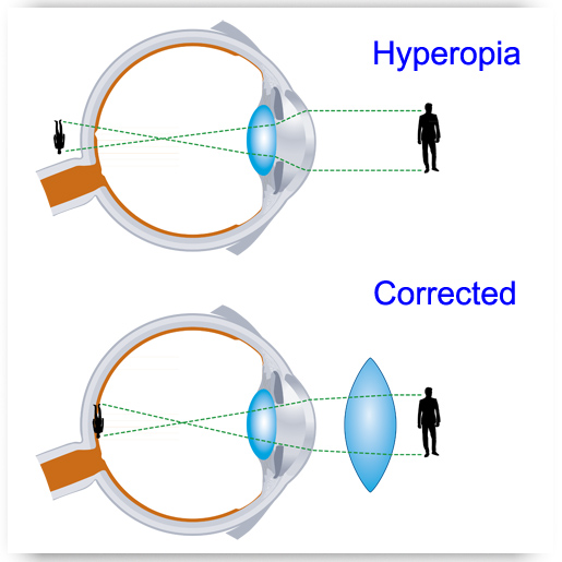 Am I Near or FarSighted? Arizona RETINA Project