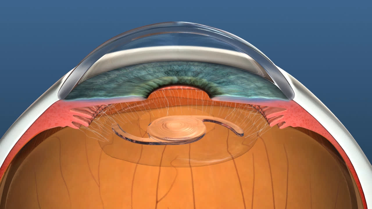 Lens Implant and Replacement William Power Laser Eye