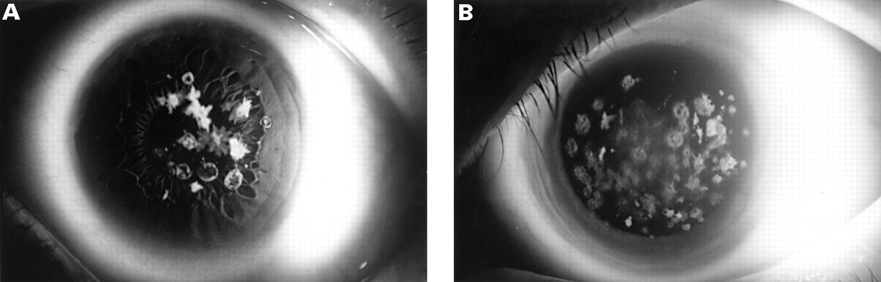Corneal guttata associated with the corneal dystrophy