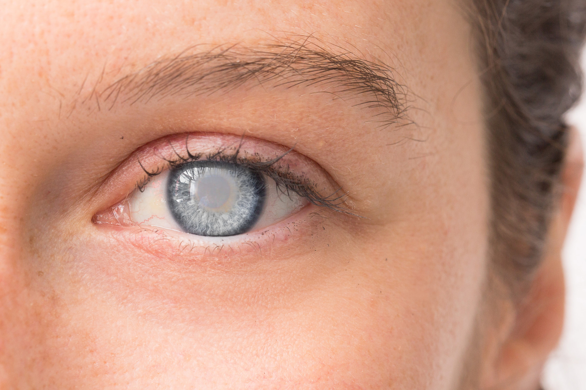 The 3 Most Common Types of Cataracts Drs. Campbell