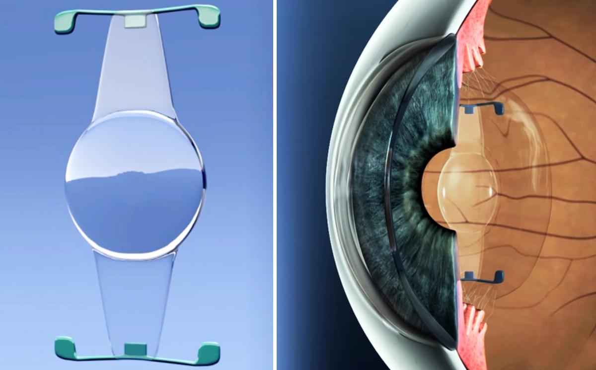 Laser Lens Exchange vs Laser Cataract Surgery Centre for
