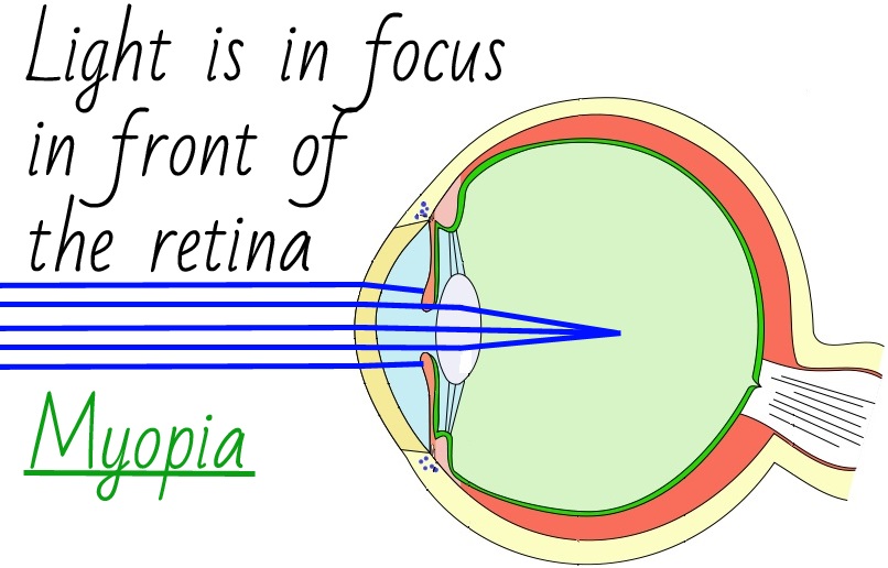What Causes Myopia And What You Can Do To Slow It Down