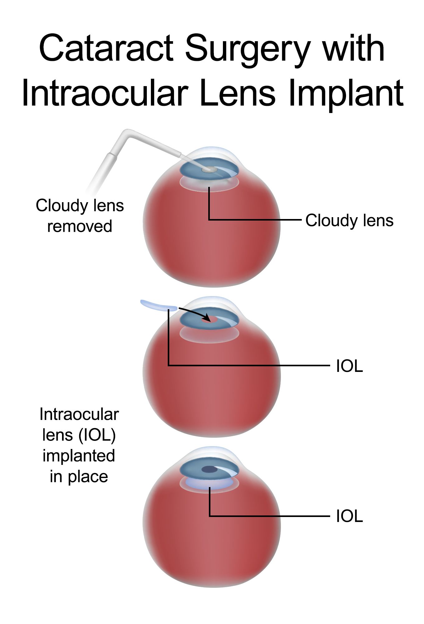 IOLs and Cataracts Goodlettsville. TN Intraocular Lenses