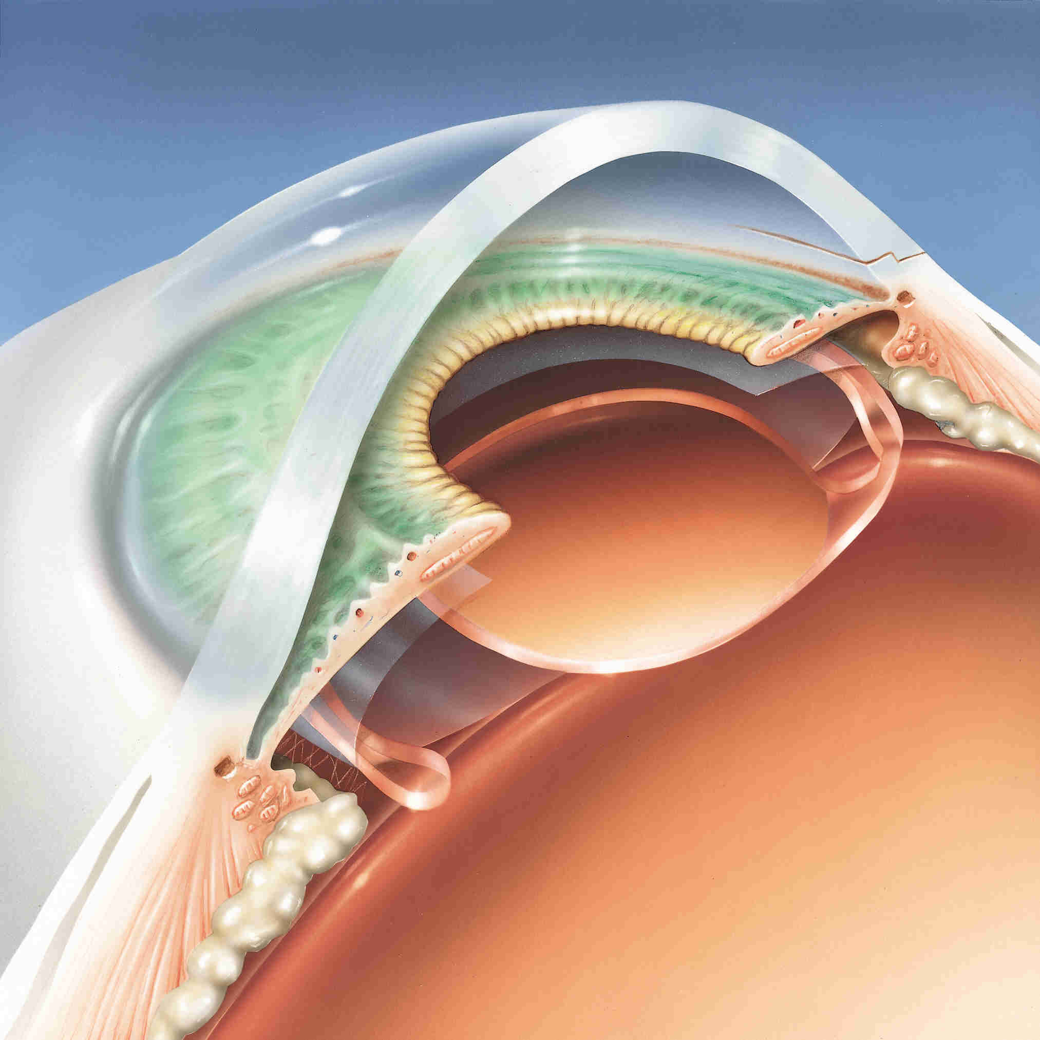Clear Lens Extraction Del Mar. CA Carmel Valley Lens