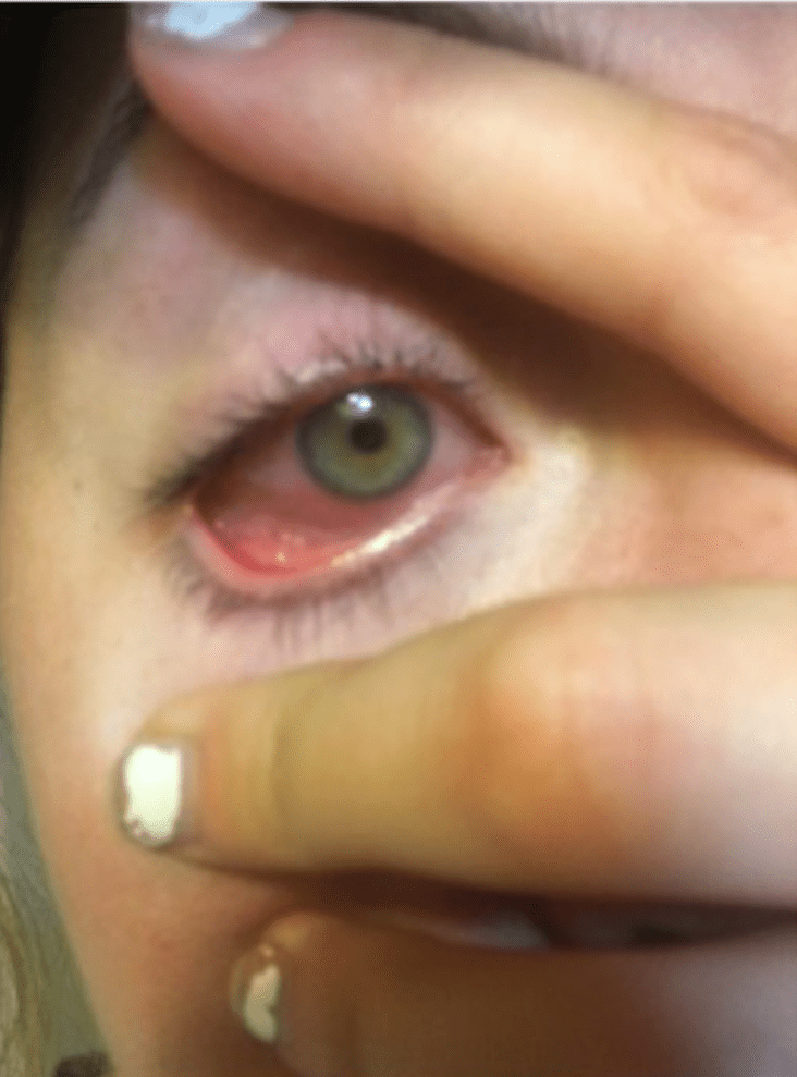 Woman left blind in one eye after parasite burrows behind