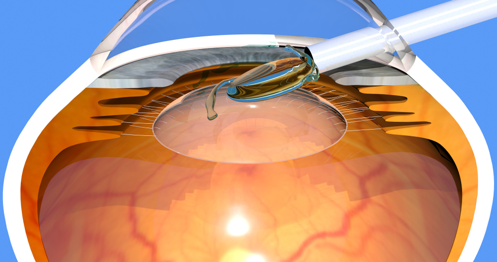 Refractive Surgery for Vision Correction Dr Lynn Yeo