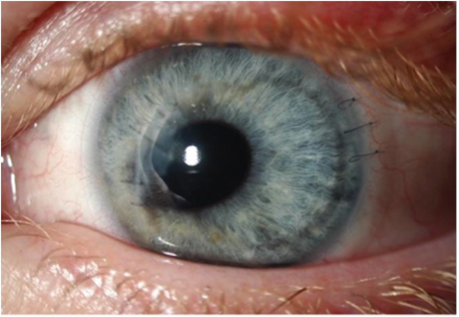 Contact lens management of irregular corneas after