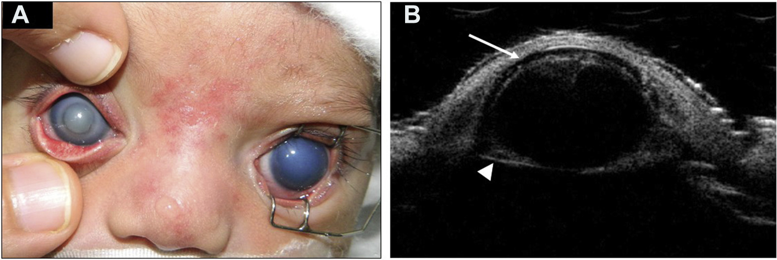 Peters Anomaly with Sequestered Lens in the Cornea