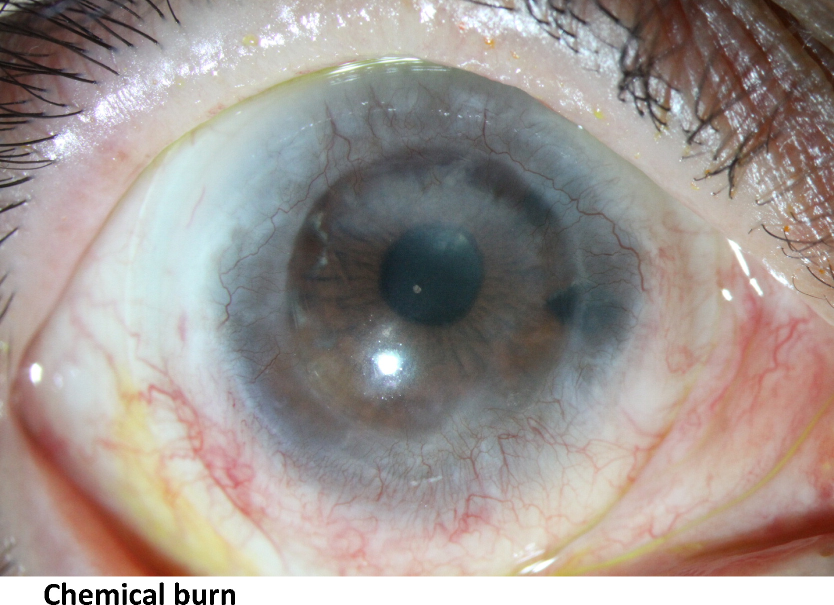 Use of mini scleral contact lenses in moderate to severe