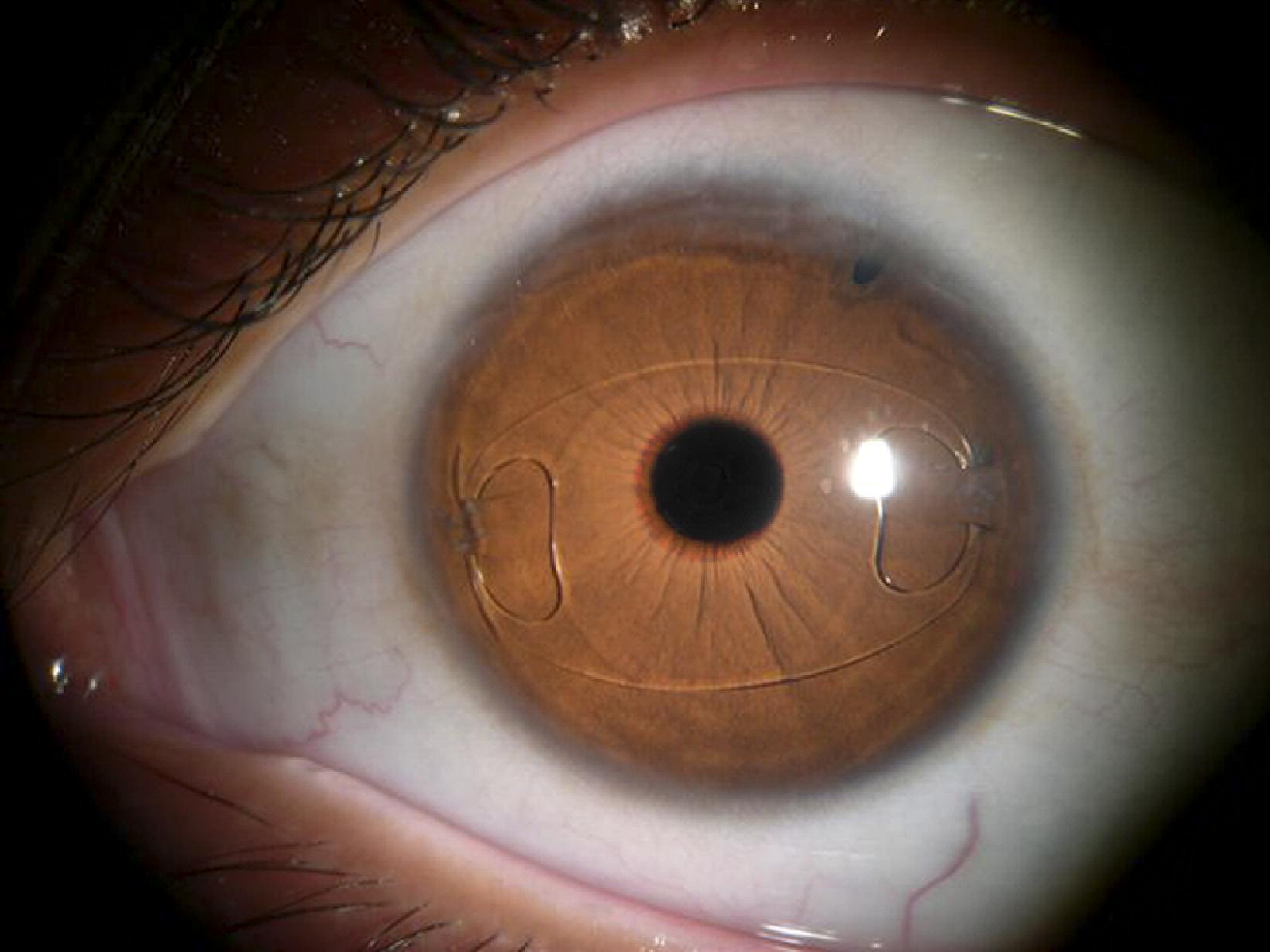 of IrisClaw Anterior Chamber versus IrisFixated