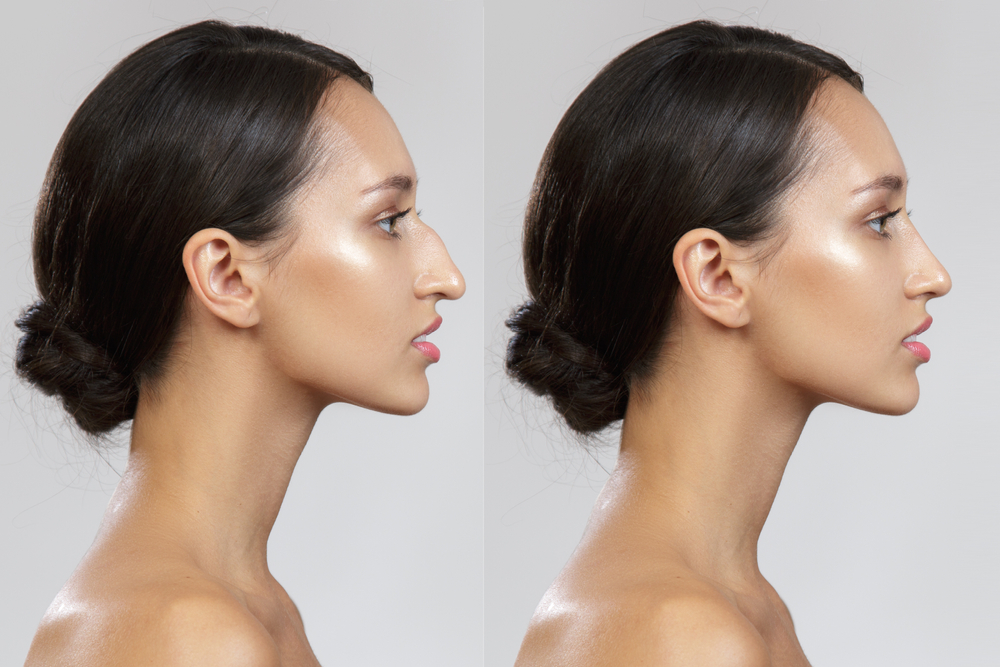 How Much Does Ethnic Rhinoplasty in Virginia Cost? Top