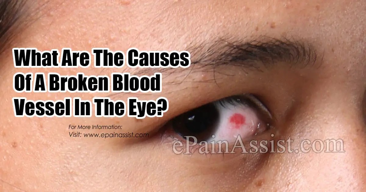 What Causes A Blood Vessel To Break In Your Eye. Its