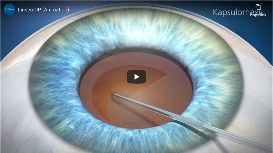Multifocal Lenses Lens Exchange Surgery at EuroEyes