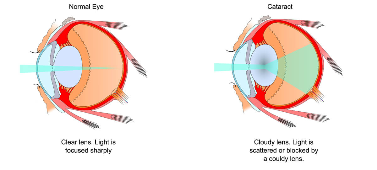 Laser Cataract Fargo Cataract Surgery Moorhead Eye