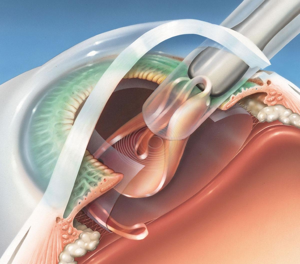 Day of Cataract Surgery Eye Care Ltd Ophthalmologists