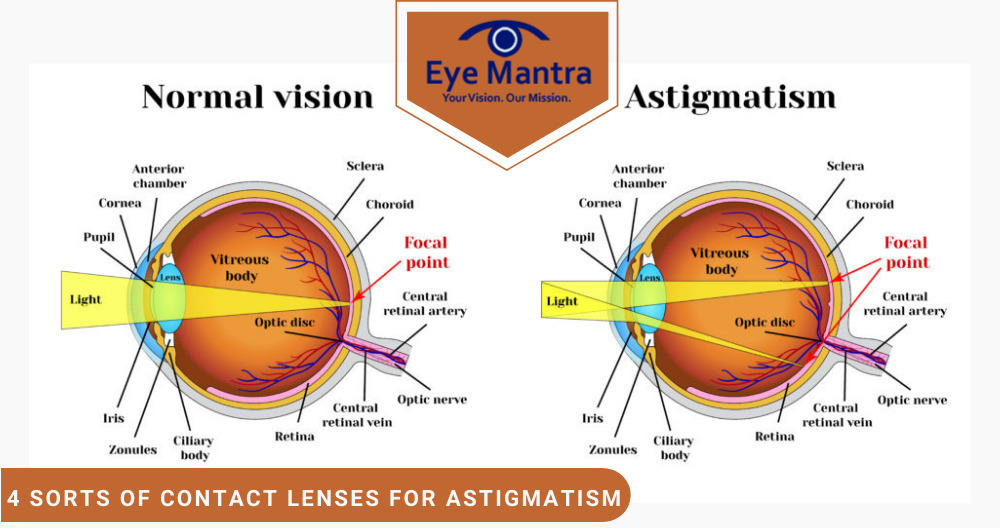 4 Corrective Lens for Astigmatism Toric. Gas. Hybrid More