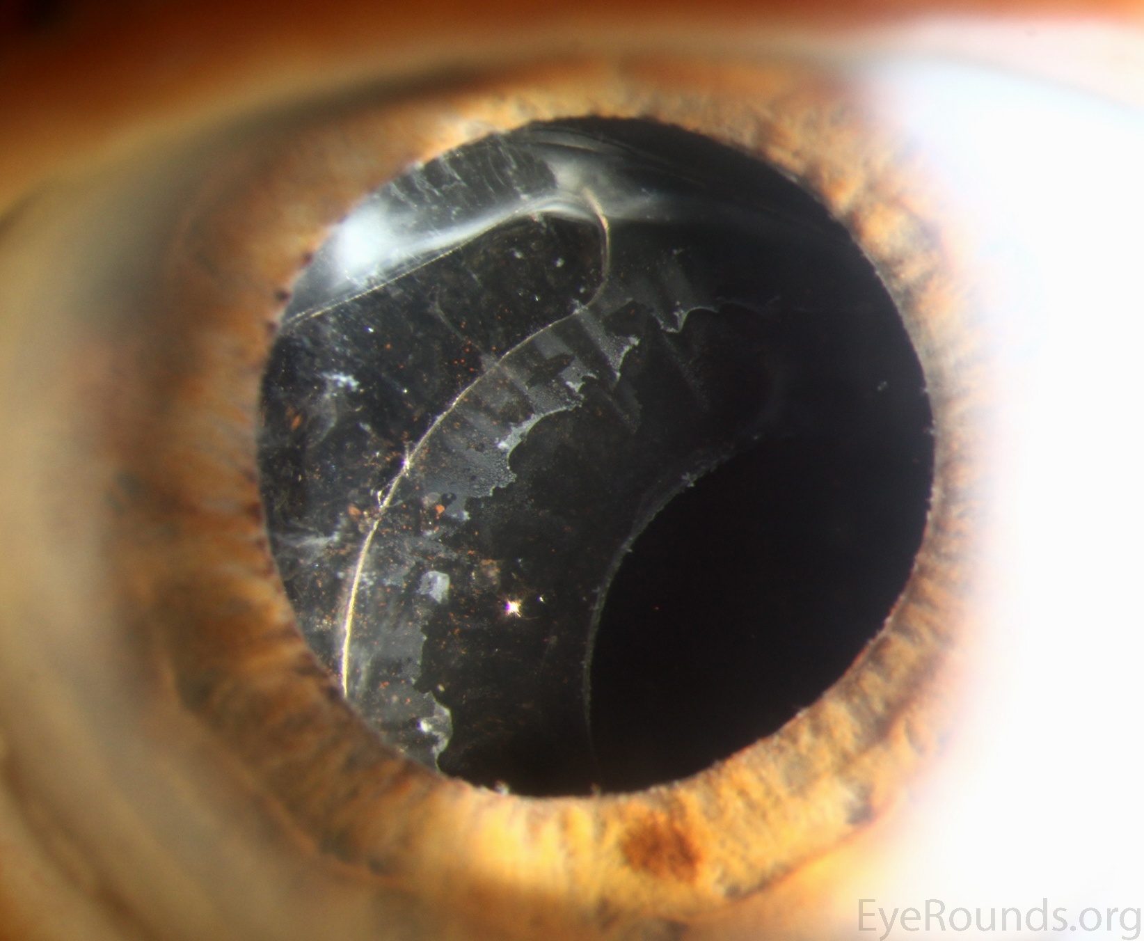 Pseudoexfoliation syndrome