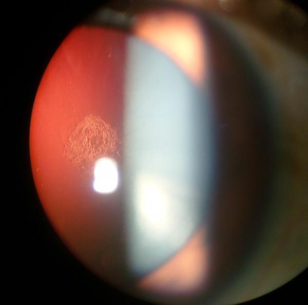 Cataract EyeWiki