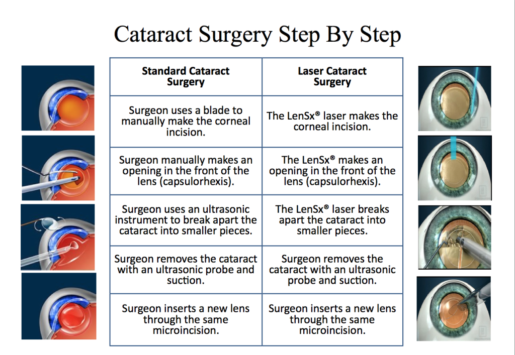 About Cataract Surgery Gailey Eye Clinic