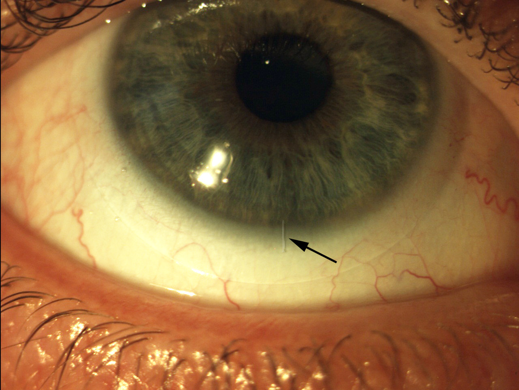 Lenses for Astigmatism