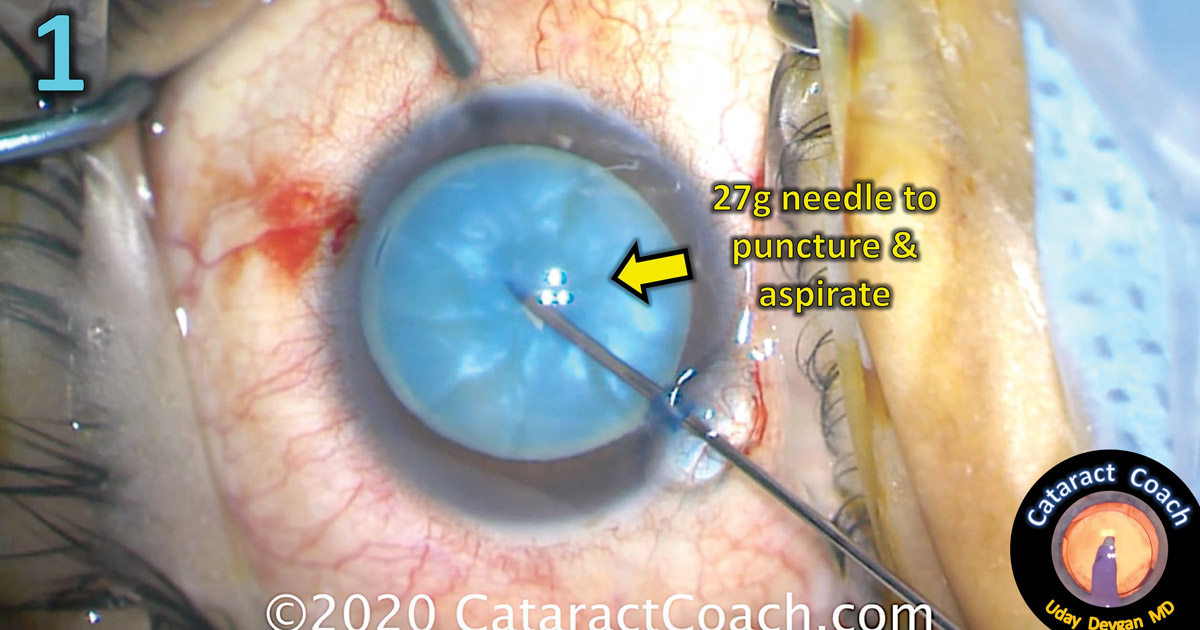 Specialized Methods Can Take Care Of Fibrotic Lens Capsule