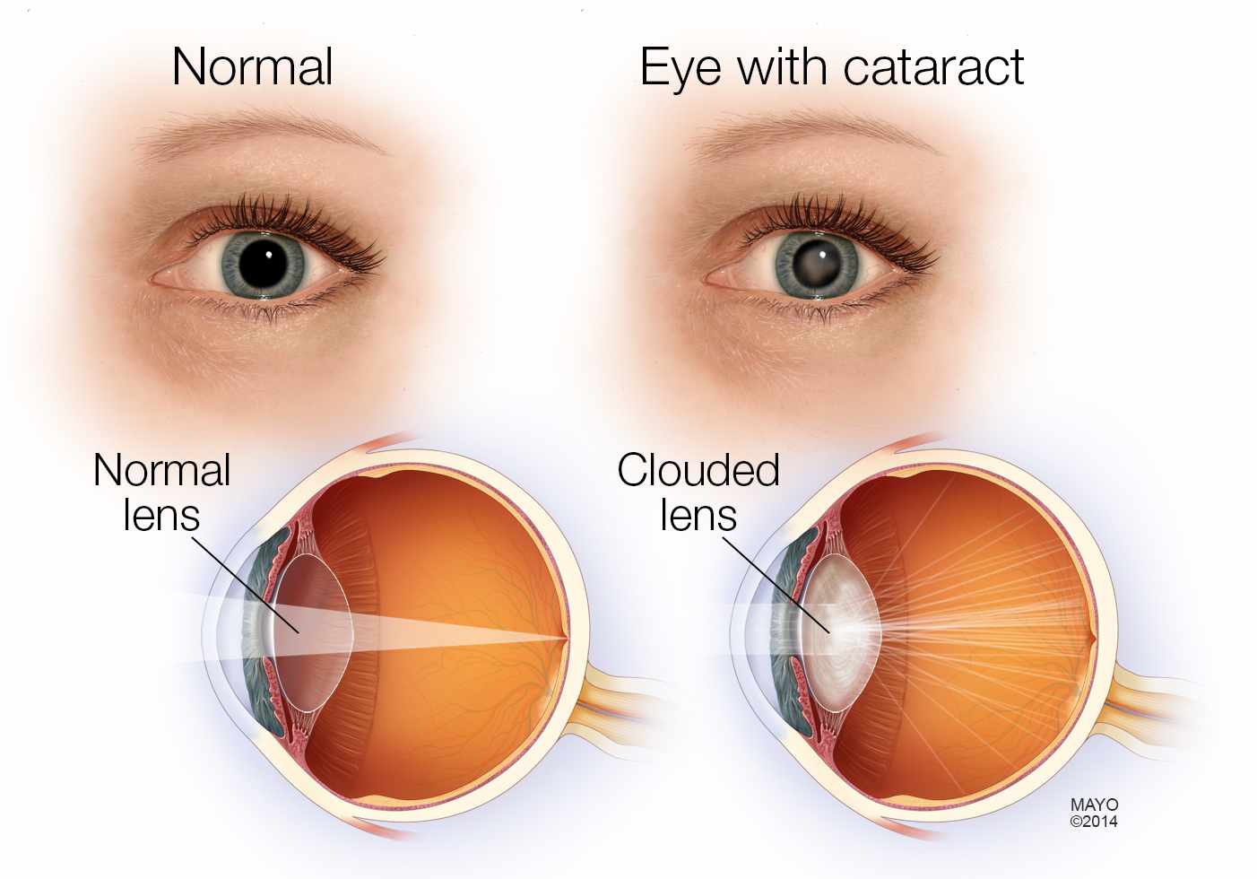 Eye Health What are Cataracts Health Life Media