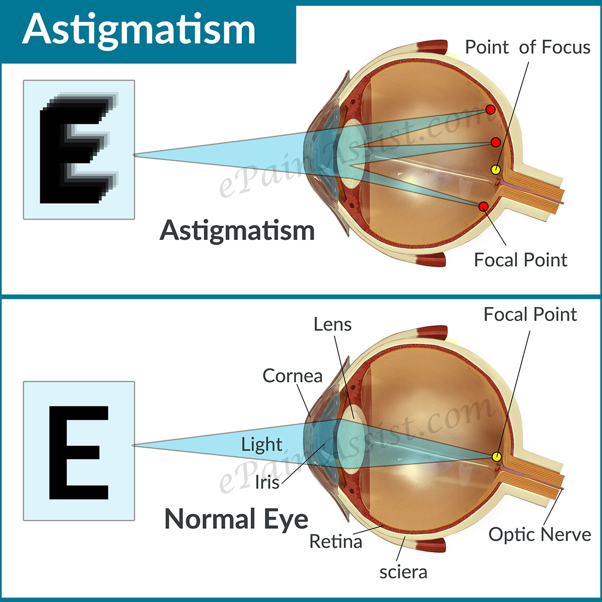 What is an Astigmatism in the Eye? Health Life Media