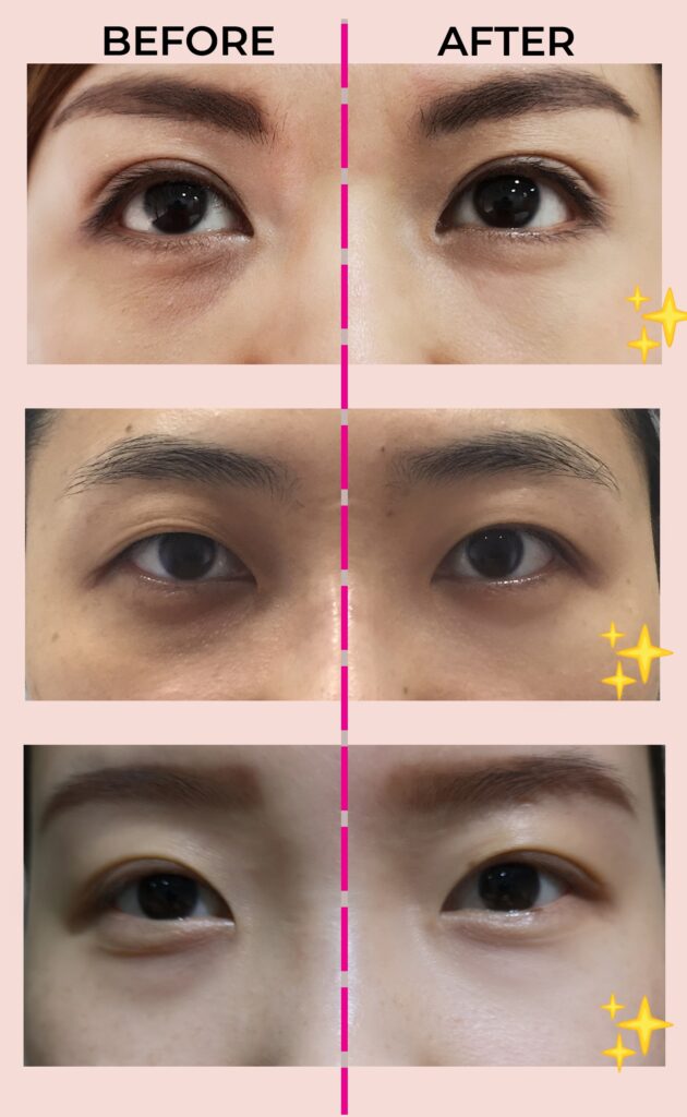 2in1 Eye treatment to reduce dark circles. eyebags