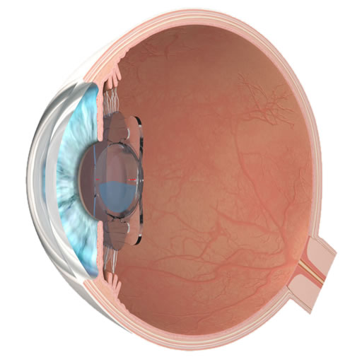 Cataract Surgery Hertfordshire Herts Eye Surgeon