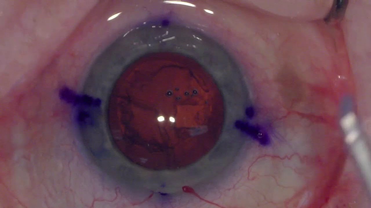Toric intraocular lens cataract surgery YouTube