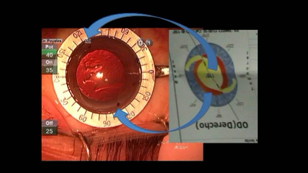 Marking and placement of a toric intraocular lens YouTube