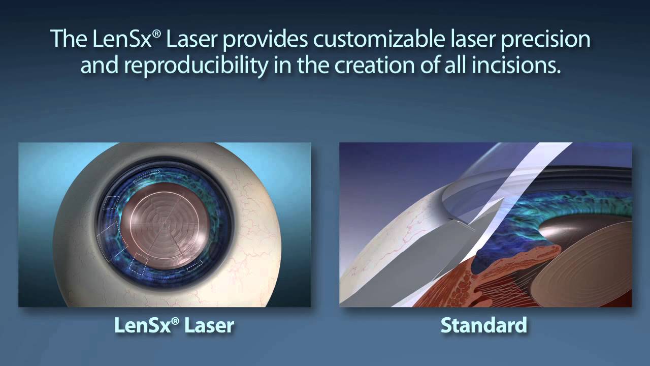 Laser Cataract Surgery vs. Traditional Cataract Surgery