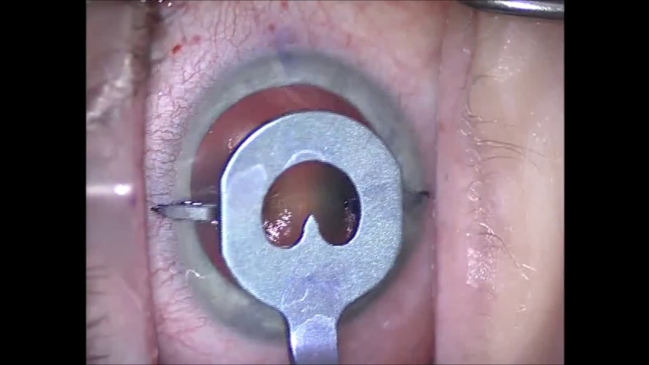 Cataract Surgery with a Symfony Toric IOL YouTube