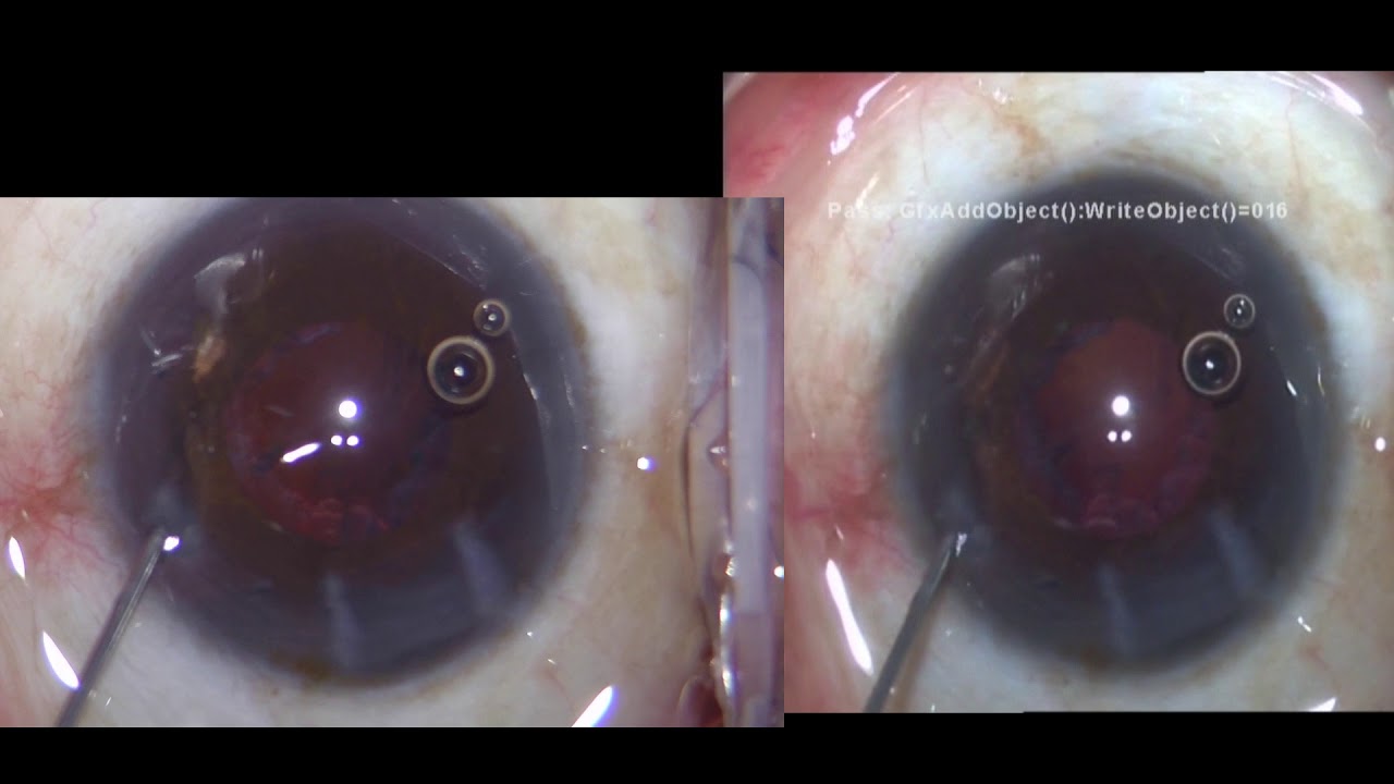 Cataract Surgery 3 Comparison. GoPro vs Sony YouTube