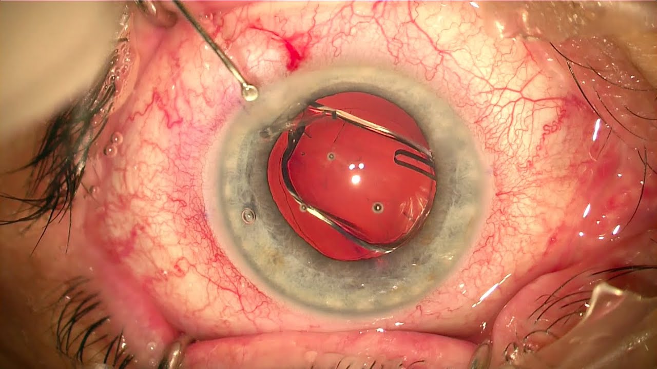 Toric Lens Cataract Surgery Catarata Lente Tórica YouTube