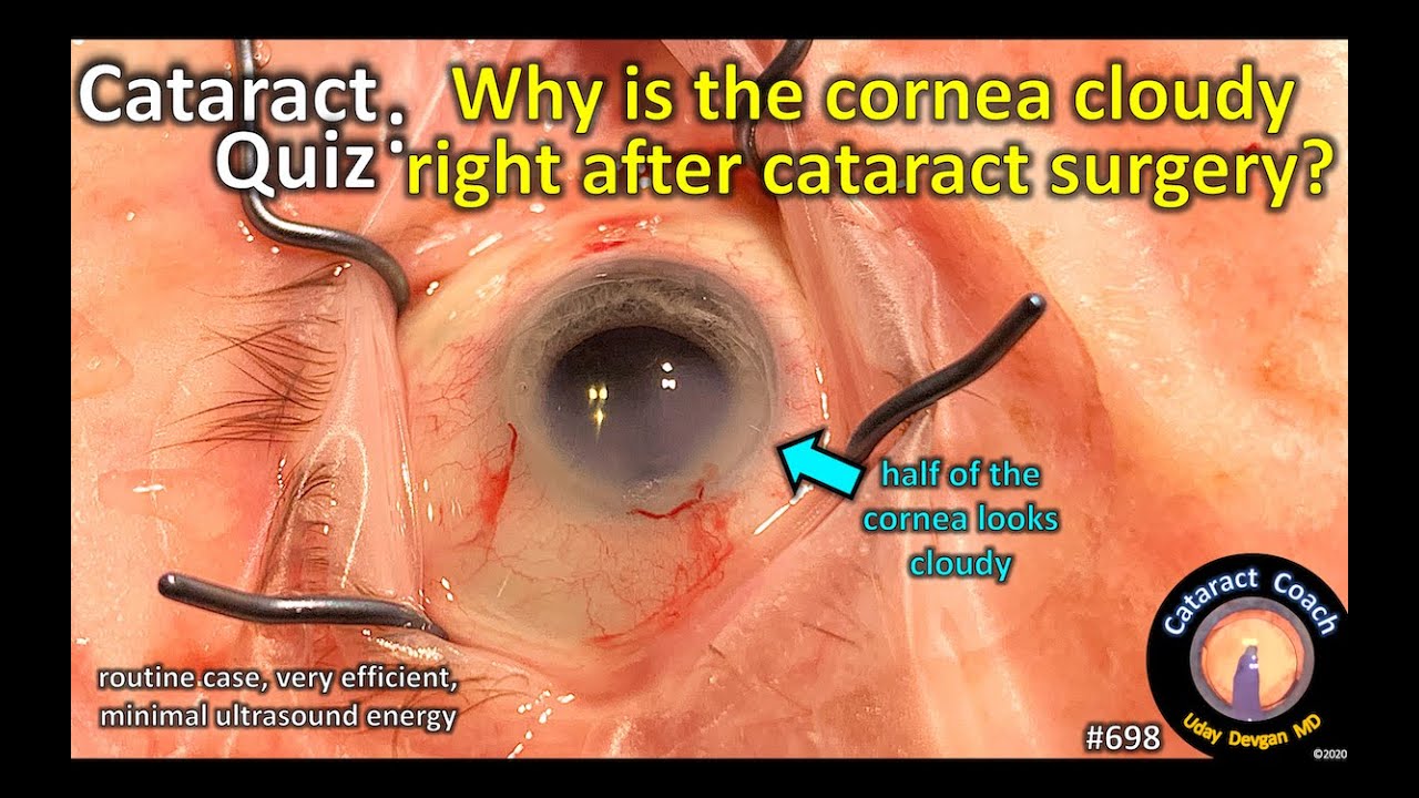Cataract Quiz Why is the cornea cloudy right after