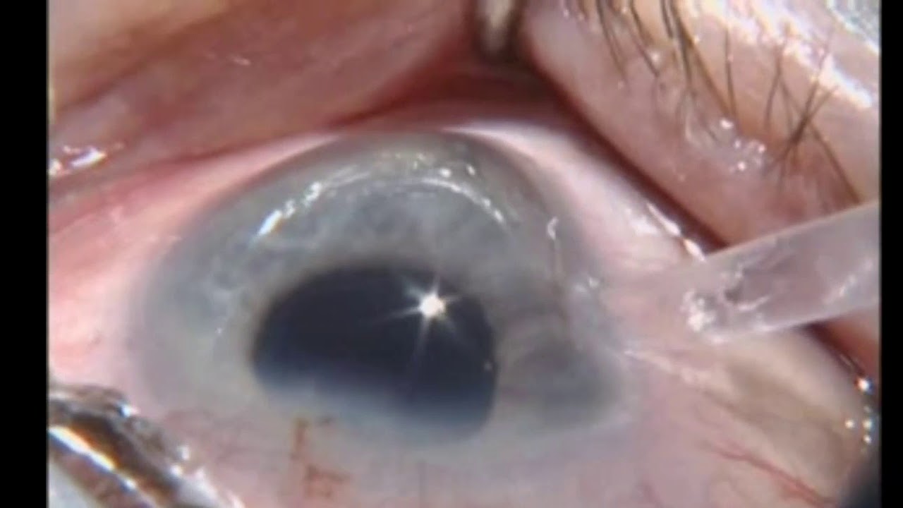 Cataract surgery YouTube