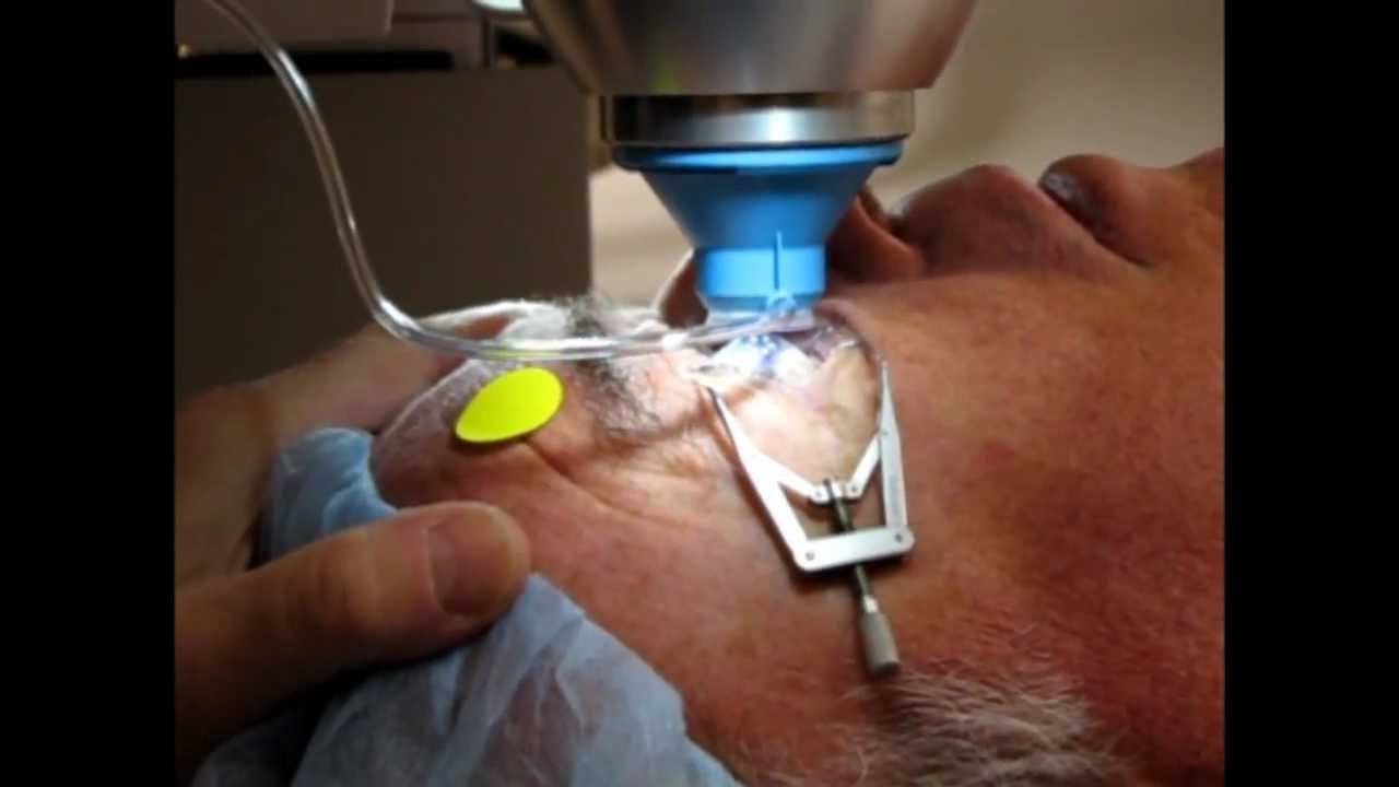 Laser Assisted Cataract Surgery YouTube