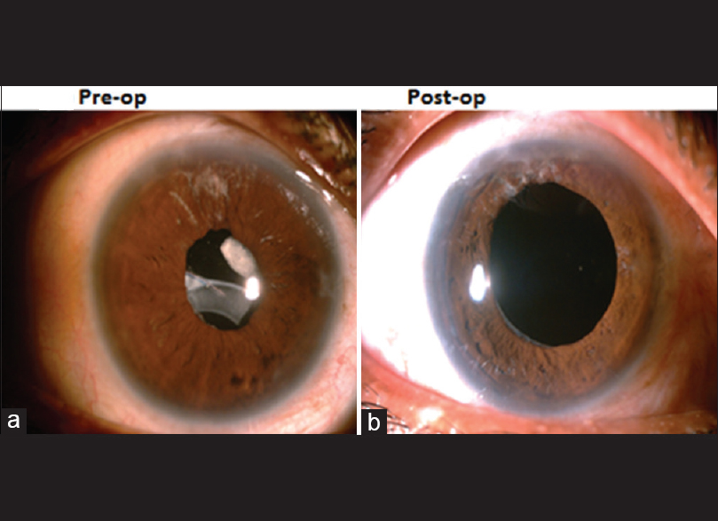 Late dislocation of inthebag intraocular lenses in
