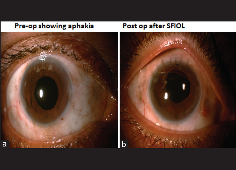 Late dislocation of inthebag intraocular lenses in