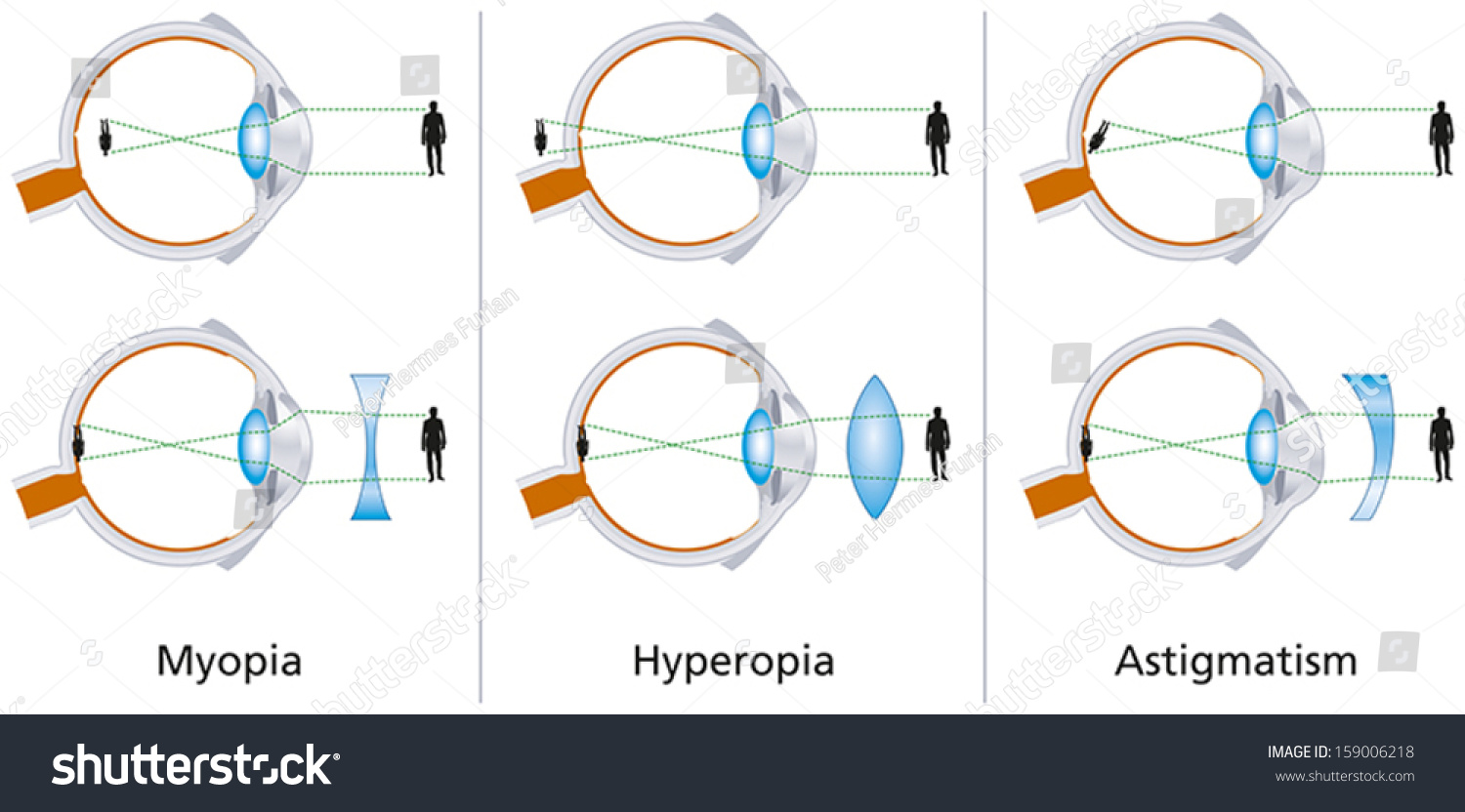 Illustration Three Visual Defects Myopia Hyperopia Stock