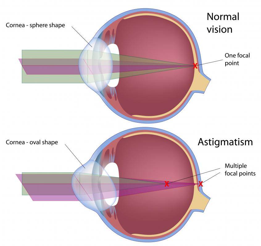 What are Corrective Lenses? (with pictures)