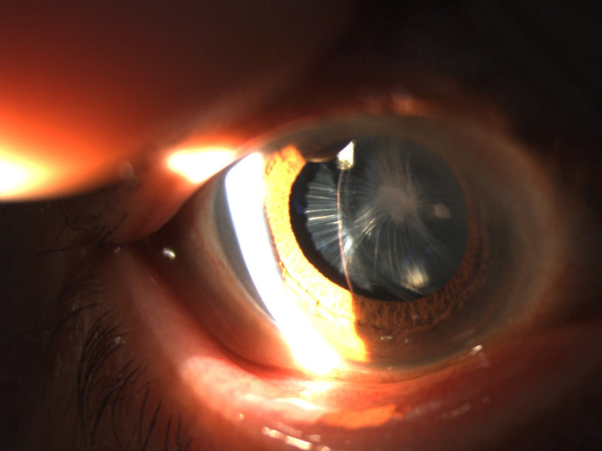 Postoperative intraocular lens dislocation due to anterior