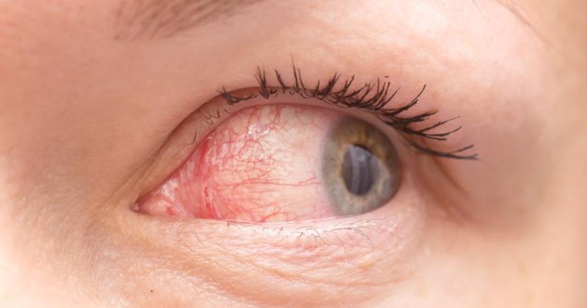 3 Ways to Prevent Spreading Pink Eye