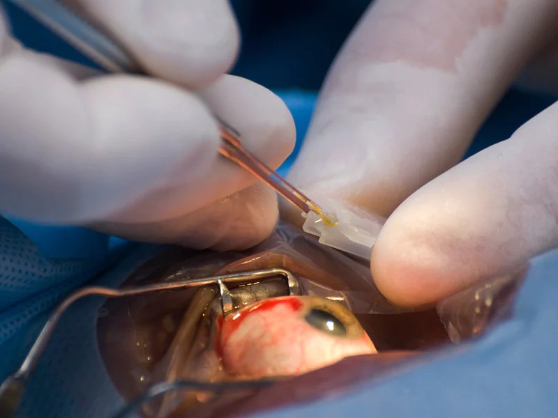 Veterans Affairs Tracks 10Year Cataract Surgery Results